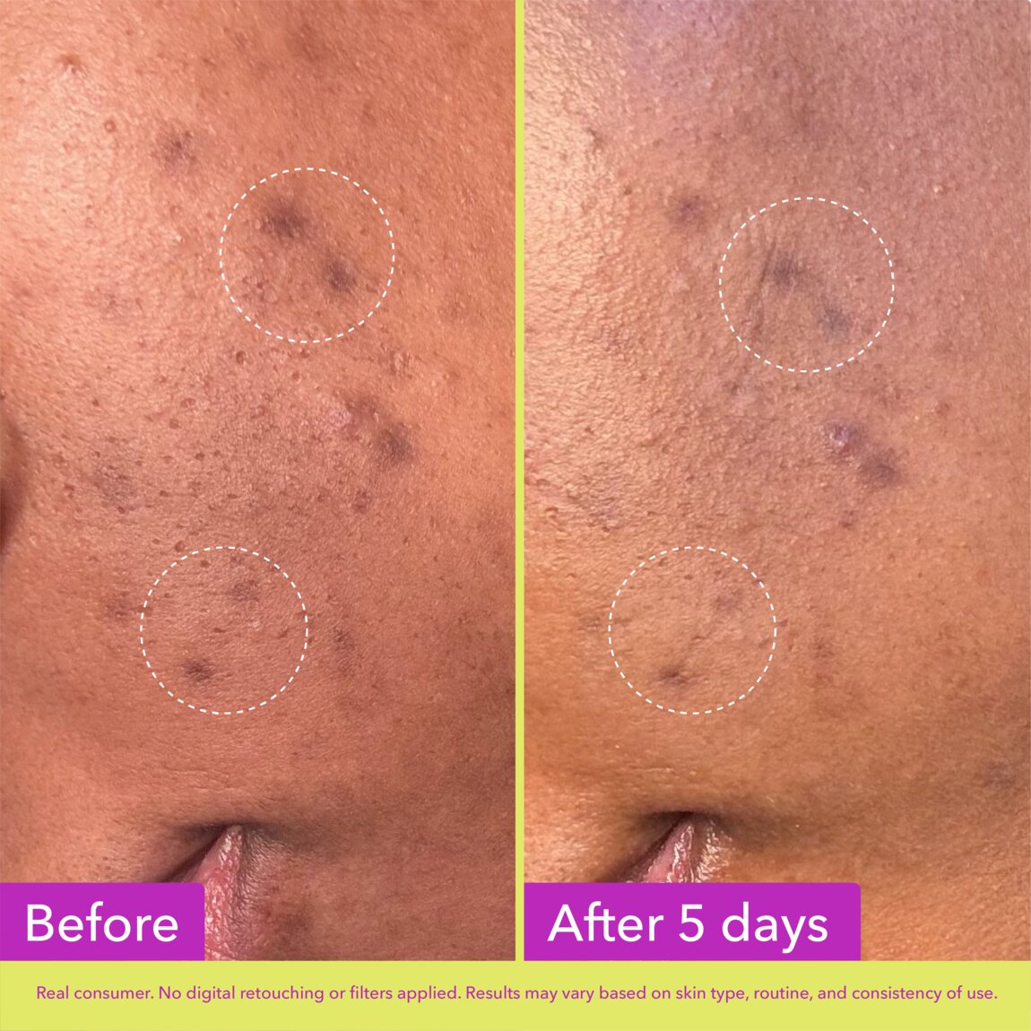 Dark Spot Microdart Patches Z1