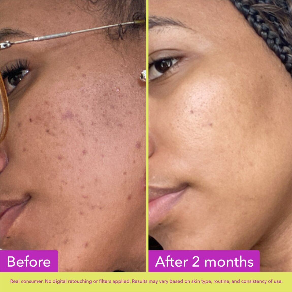10% Azelaic Acid Treatment Q7