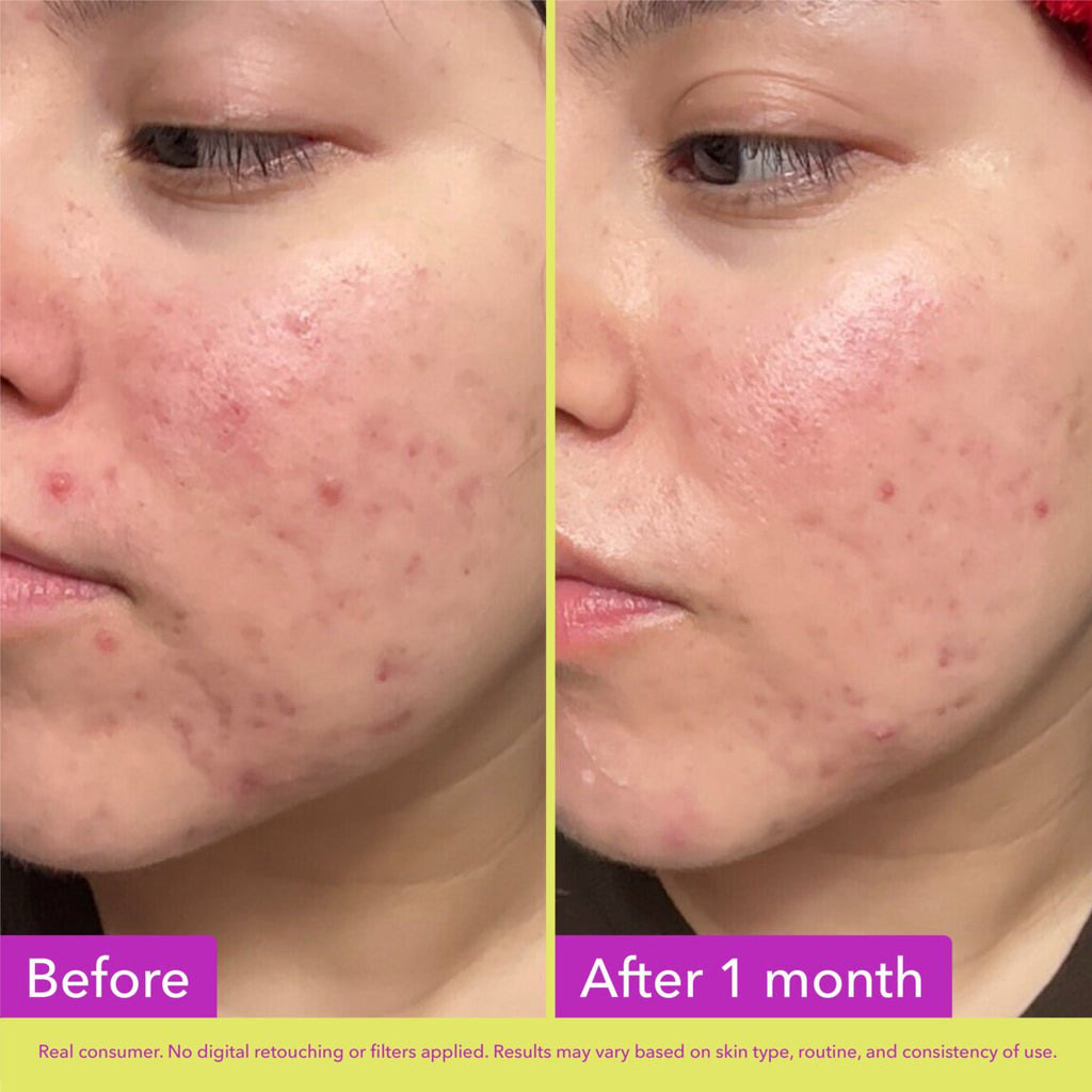 10% Azelaic Acid Treatment Q7
