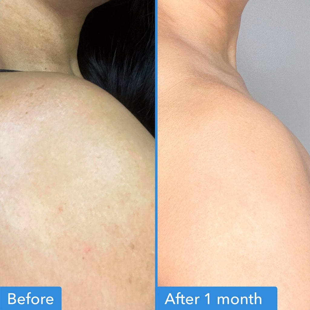 Discoloration Correcting Body Treatment Q6