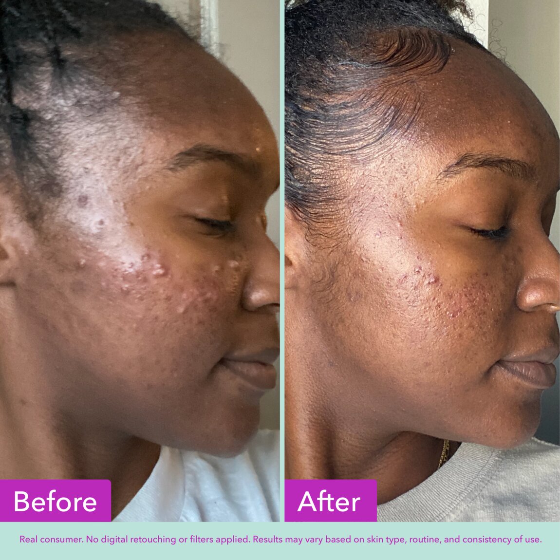 Acne Foaming Cleanser X6