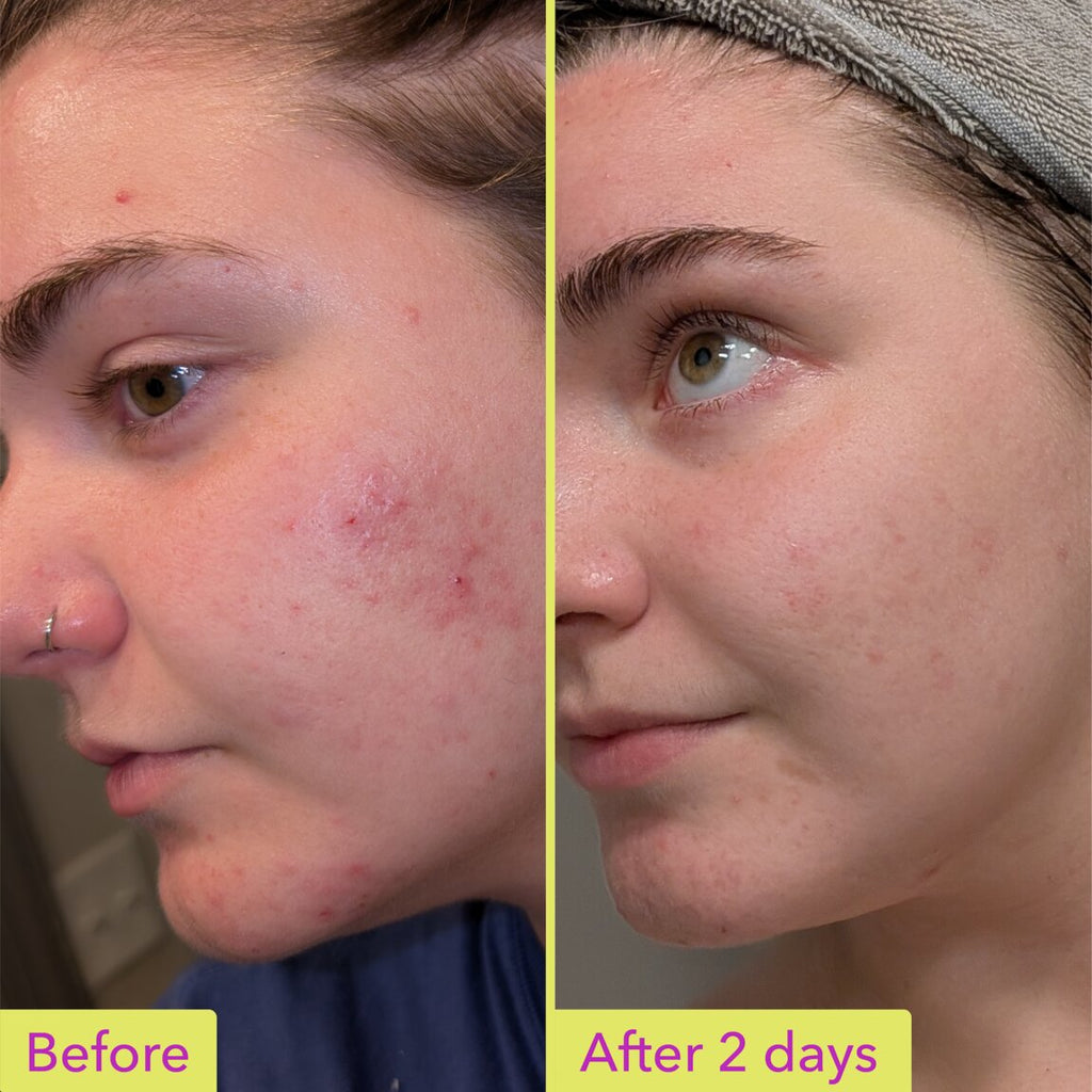 10% Azelaic Acid Treatment Q7